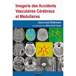 Imagerie Des Accidents Vasculaires CÃ©rÃ©braux Et MÃ©dullaires