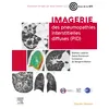 Image de Imagerie des pneumopathies interstitielles diffuses (PID)